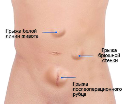 Виды послеоперационных грыж Грыжа после удаления желчного пузыря