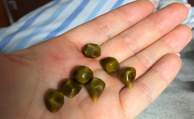 Лечение и вывод кальцинированных образований Кальцинирование желчных камней