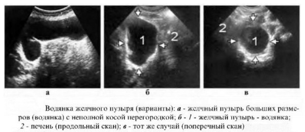 Как проявляется водянка? Водянка желчного пузыря