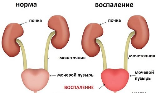 Патологии желчного пузыря Какие продукты нельзя есть при камнях в желчном пузыре?