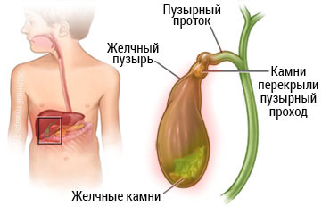 Характеристика желчнокаменной болезни Камни в желчном пузыре у ребенка