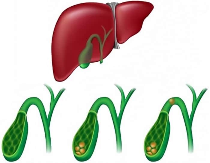 Симптомы закупорки камнем желчной протоки Закупорка камнем в протоке желчного пузыря. Что делать?