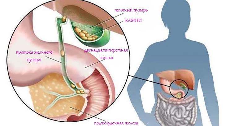 Опасности застойных желчных явлений Взвесь в желчном пузыре