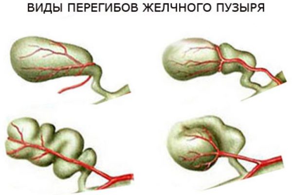 Симптоматика перегибов Желчегонные препараты при перегибе желчного пузыря