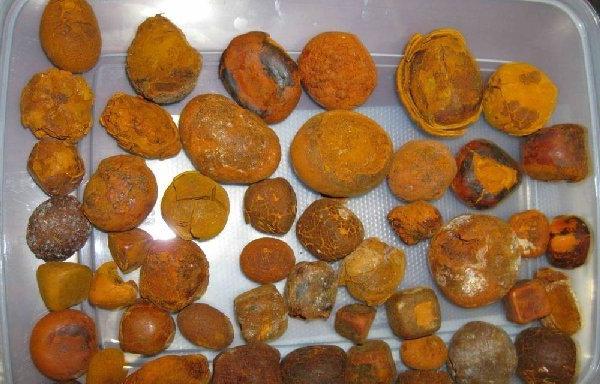 Частота появления желчных камней Желчный камень в протоке