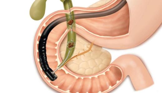 Когда необходима операция при желчных камнях? Лечение лазером камней в желчном пузыре
