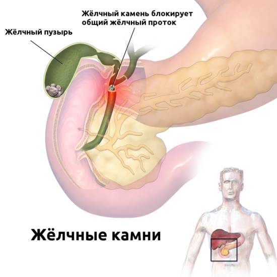 Симптоматика этого заболевания Чем лечить камни в желчном пузыре?