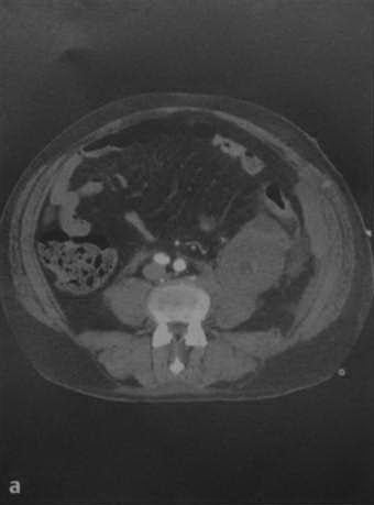 Снимки МРТ и КТ. Трансплантация почки