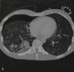 Снимки МРТ и КТ. Ушиб и разрыв легкого