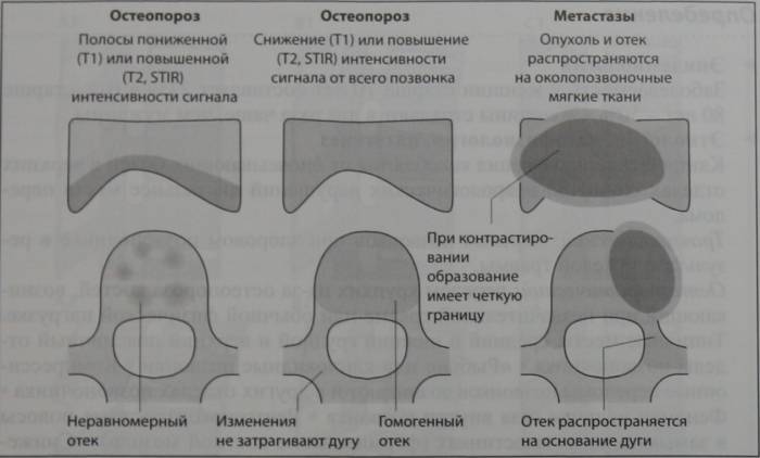 Снимки МРТ и КТ. Переломы позвоночника: причины