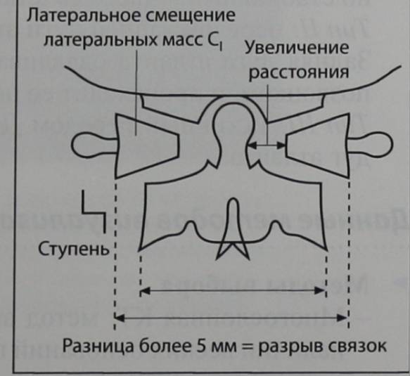 Снимки МРТ и КТ. Перелом Джефферсона