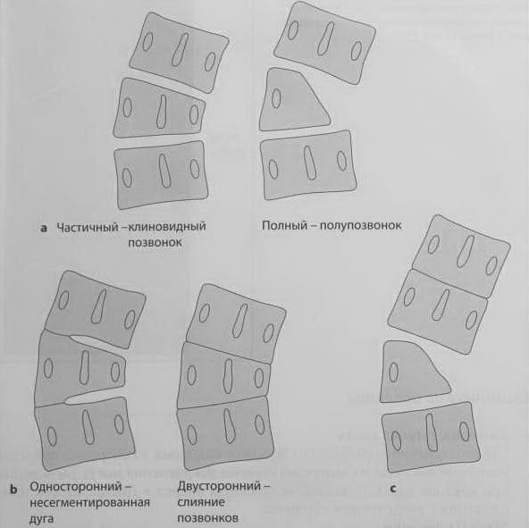 Снимки МРТ и КТ. Сколиоз
