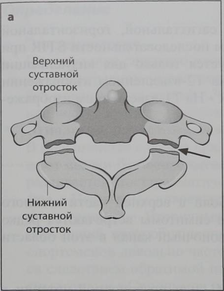Снимки МРТ и КТ. Перелом повешенных