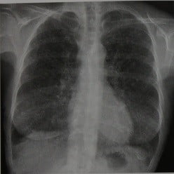 Снимки МРТ и КТ. Метастазы в легкие