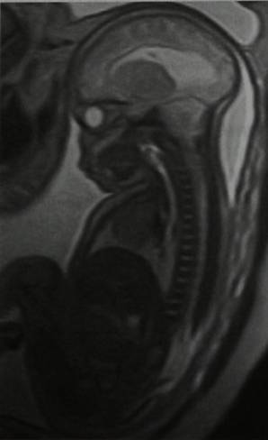 Снимки МРТ и КТ. Синдром Арнольда-Киари