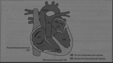Снимки МРТ и КТ. Аномалия Эбштейна