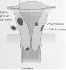 Снимки МРТ и КТ. Лейомиома