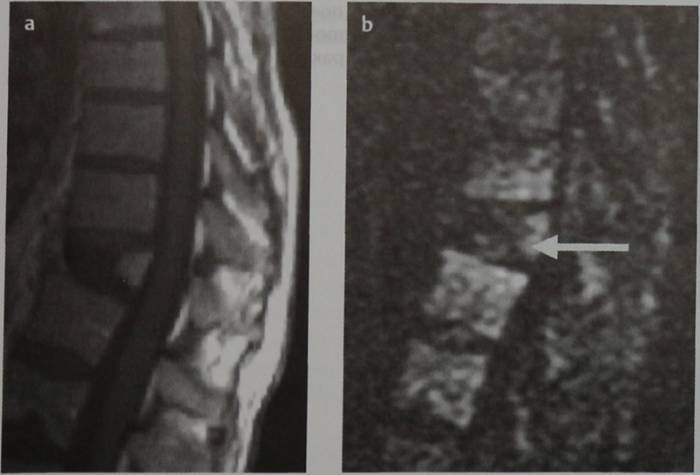 Снимки МРТ и КТ. Метастазы в кости