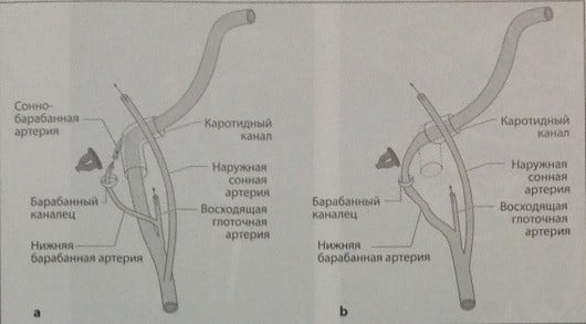 Снимки МРТ и КТ. Аберрантная внутренняя сонная артерия